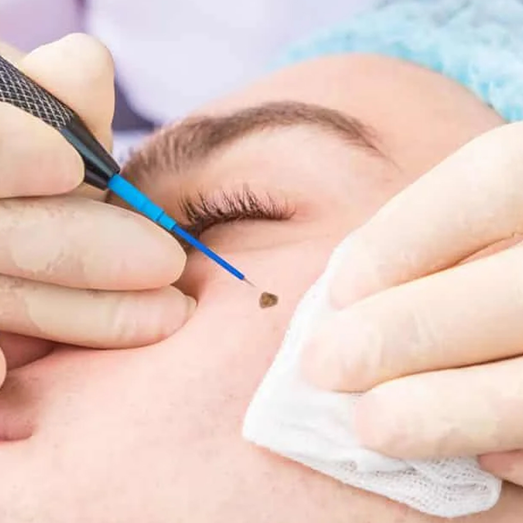 Hair Restoration Treatment