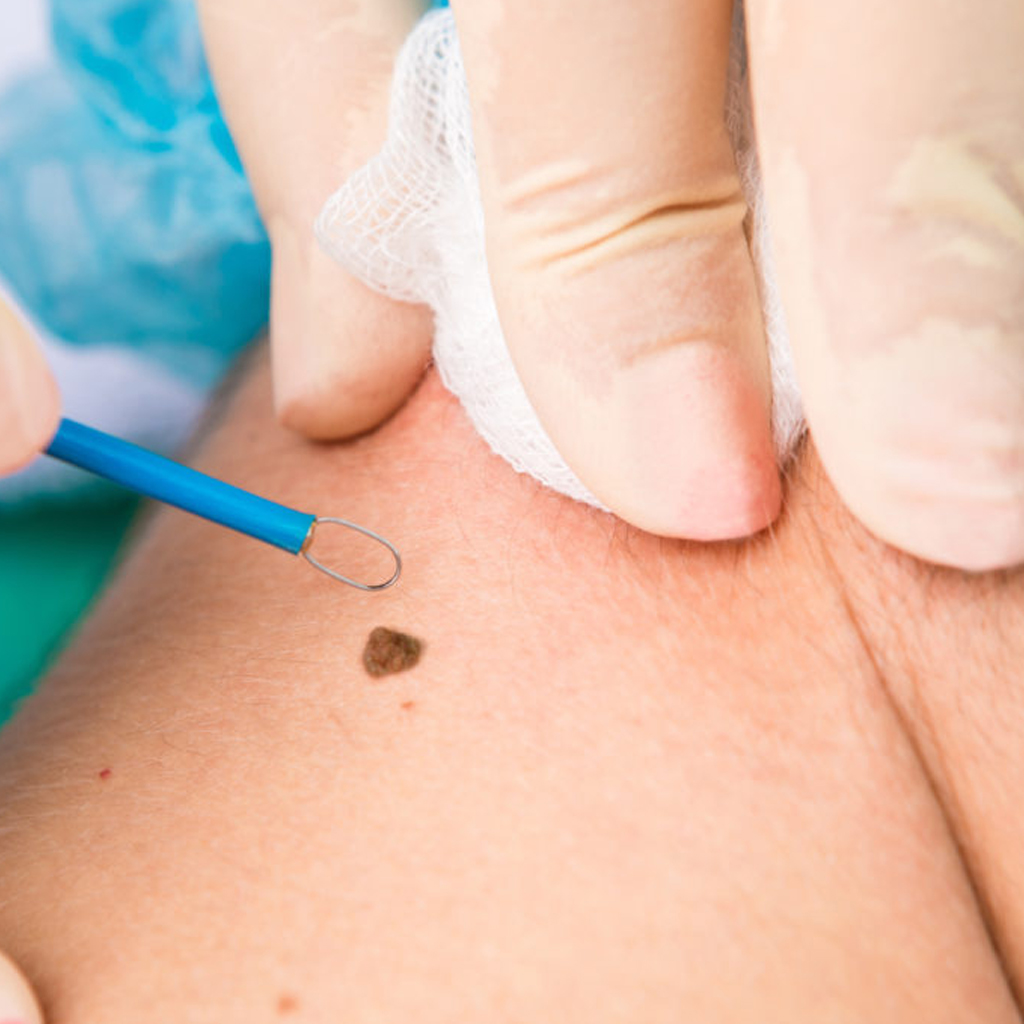 Wart And Mole Removal